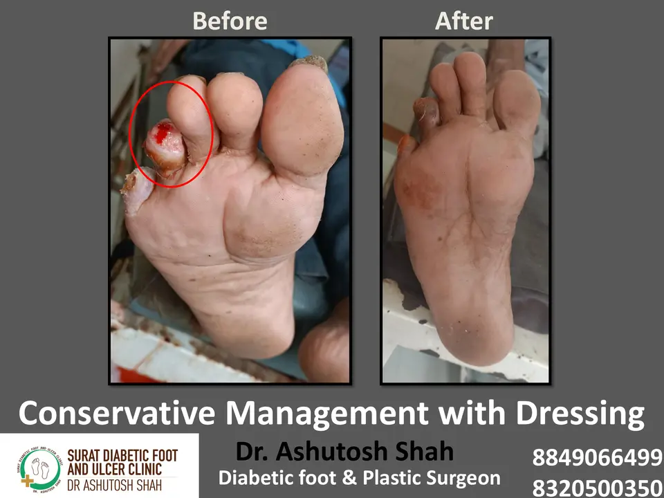 Diabetic Foot  PPT 3 checked by sir.pptx-45.webp